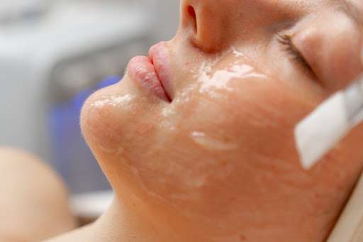 Peeling chimico: perché sceglierlo